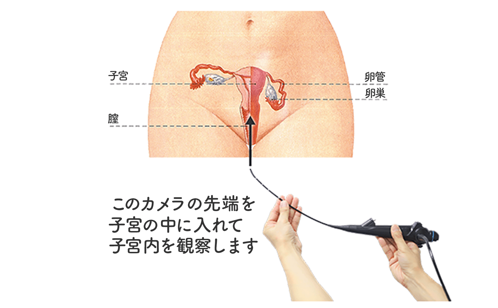 膣 内 カメラ